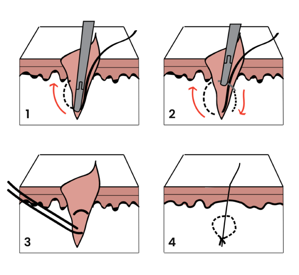 deep-dermal-suture-app